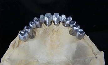 Couronne sur implant Bassens (73000)